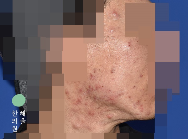 [울산점] 얼굴화농성여드름 치료 전 사진 - 해율한의원